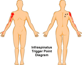 supraspinatus trigger points