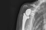 Reverse Total Shoulder Arthroplasty