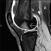 Imaging of Joint Injuries in Athletes - Physical Therapy - CyberPT